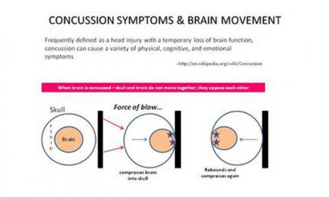 Concussion Symptoms and Brain Movement
